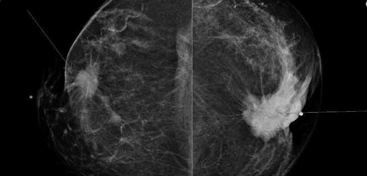 mammographie-depistage-cancer-sein-radiotherapie