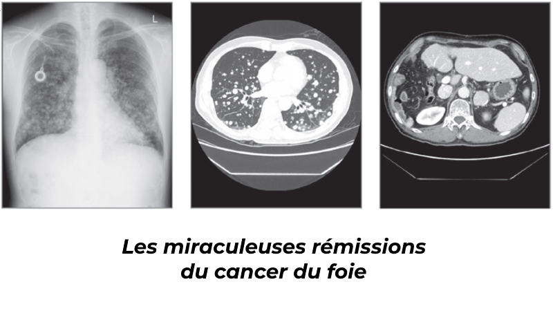 Cancer du foie : les enseignements des guérisons plus médiatiques ...